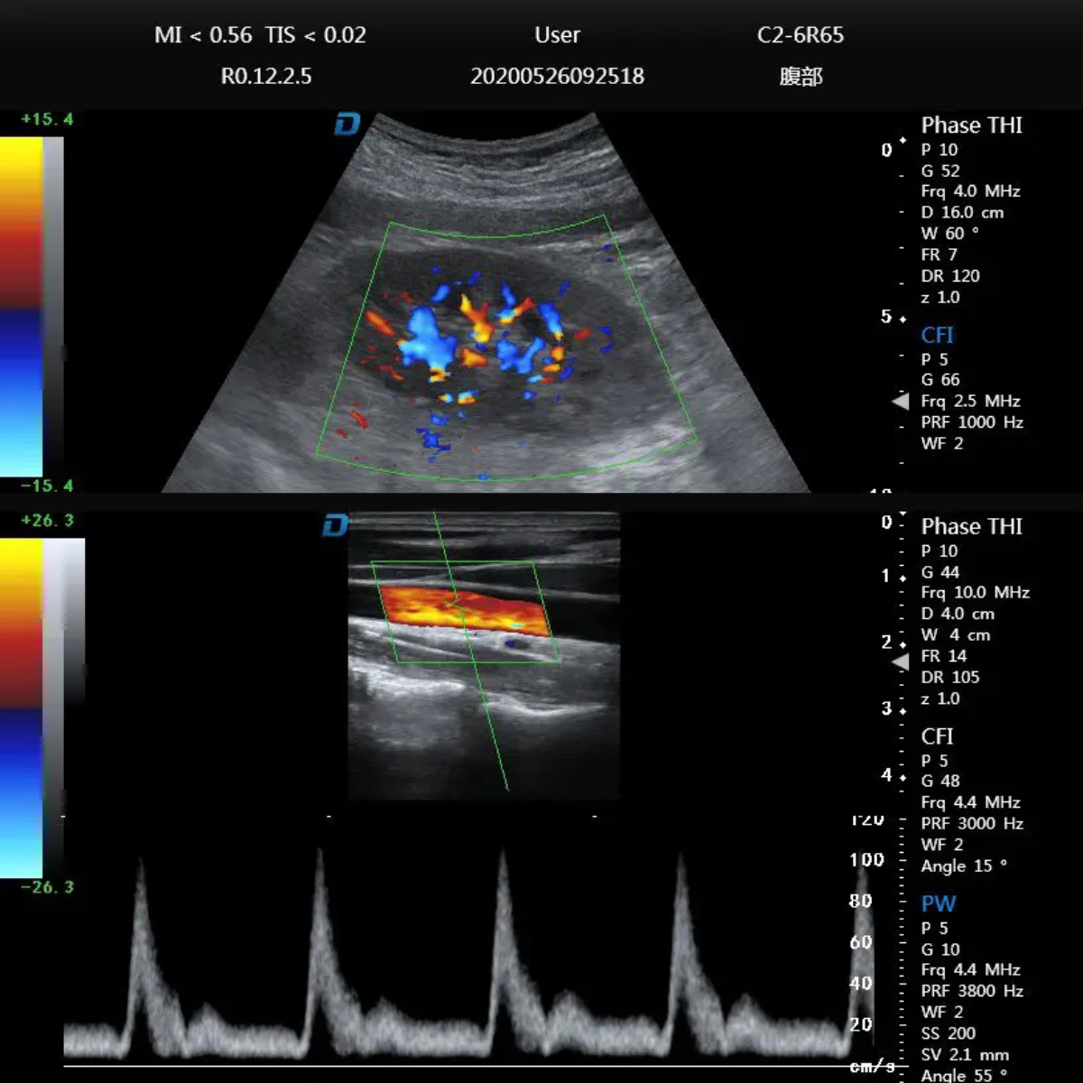 ECÓGRAFO PORTÁTIL PROFESIONAL DAWEI DW-P8 CON DOPPLER TISULAR, TDI Y STRAIN CARDÍACO