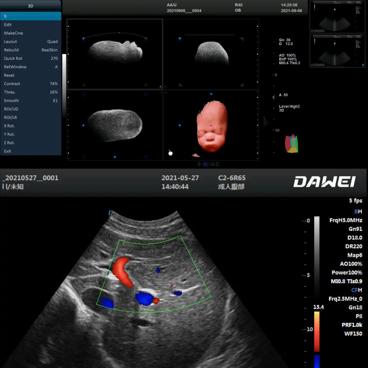 ECÓGRAFO PORTÁTIL PROFESIONAL DAWEI DW-P50 4D/5D LIVE CON DOPPLER COLOR Y ALTA RESOLUCIÓN